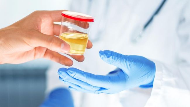 Penyakit Ginjal Bisa Dilihat dari Air Kencing, Ini Ciri-cirinya