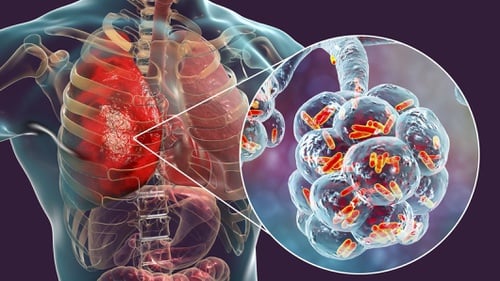 10 Ciri-ciri Infeksi Paru-paru yang Tak Disadari Seperti Diidap Tjahjo Kumolo