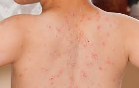 Tekan Kasus Campak, Pemprov Riau Gencarkan  Program Imunisasi dan Edukasi