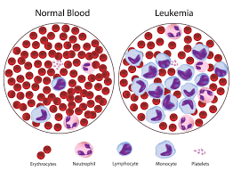 Penderita Kanker Darah di RI Meningkat, Mayoritas Idap Leukemia
